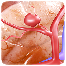 Aneurysms