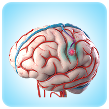 Cavernous Malformations (including deep seated and brainstem)