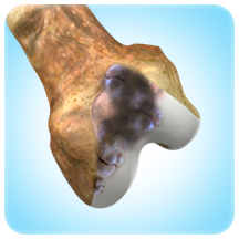 Chordoma and Chondrosarcoma