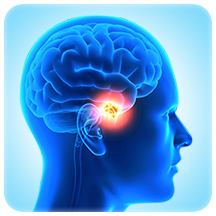 Craniopharyngioma