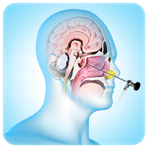 Endoscopic Endonasal Neurosurgery