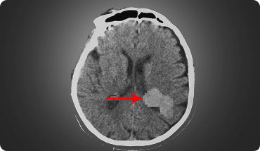 Ventricular Meningiomas